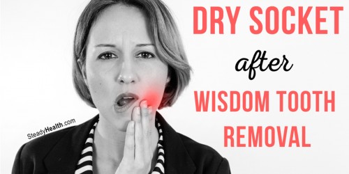 Dry Socket After Wisdom Tooth Removal