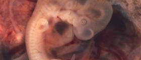 Signs And Symptoms Of An Ectopic Pregnancy