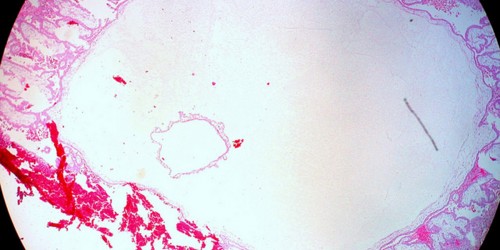 Ectopic Pregnancy: Beyond The Fallopian Tubes