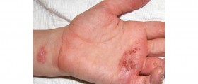 Natural Treatments for Eczema