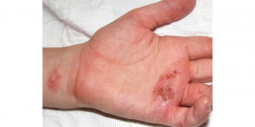 Natural Treatments for Eczema