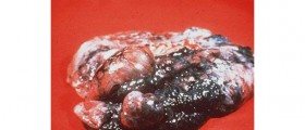 Lung Diseases: Emphysema & tobacco smoke