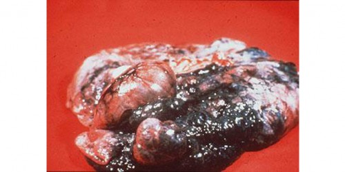 Lung Diseases: Emphysema & tobacco smoke