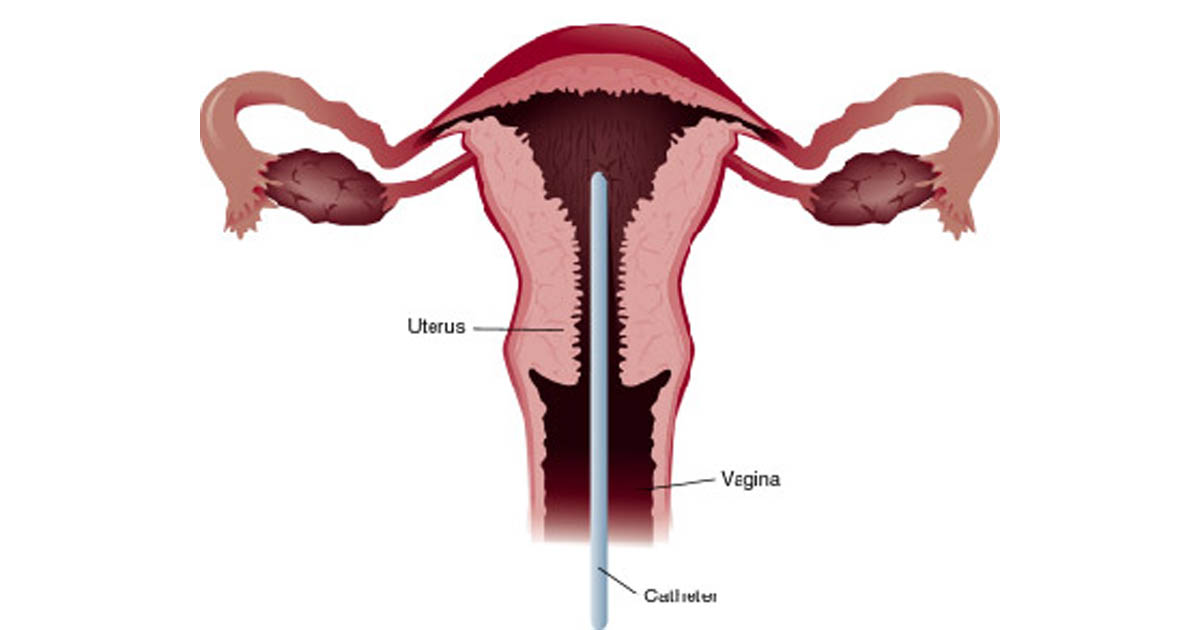 endometrial-biopsy