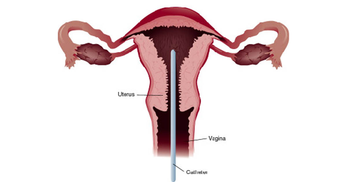 endo biopsy uterus