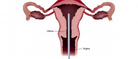 Endometrial Biopsy Procedure