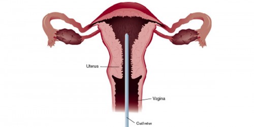 Endometrial Biopsy Procedure