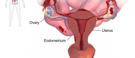 Endometriosis - Symptoms, Diagnosis And Treatment