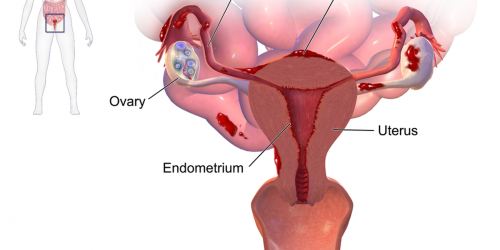 Endometriosis - Symptoms, Diagnosis And Treatment
