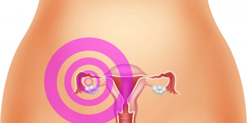 Endometriosis & Hysterectomy