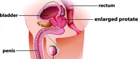 Enlarged prostate: Prostate Laser Surgery