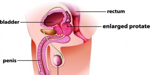 Enlarged prostate: Prostate Laser Surgery