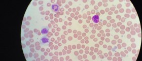 Essential Thrombocytosis