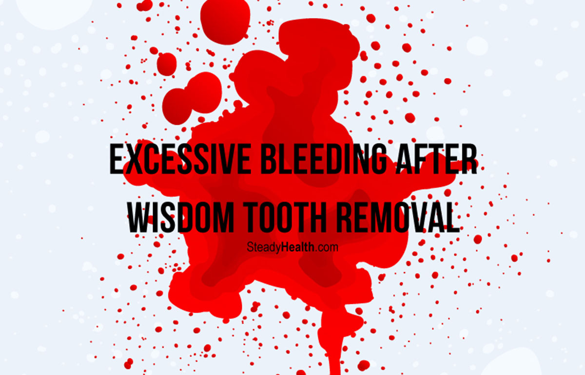 Bleeding After Tooth Extraction And Bone Graft at Marie Lynn blog