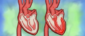 Myocarditis: Symptoms, Diagnosis and Prevention
