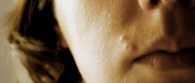 Acne Scars Treatment Options