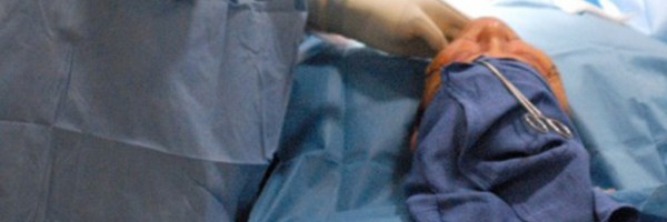 Facelift (Rhytidectomy): Procedure, Risks, and Recovery