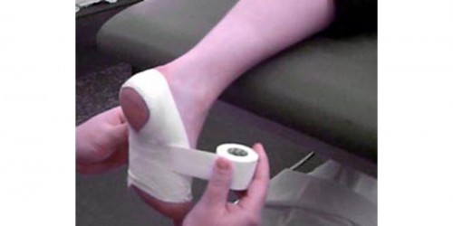 Plantar Fasciitis: Causes, Symptoms & Treatment