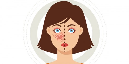 Fibromyalgia And Lupus: Is There Any Hope For A Pain-Free Life?