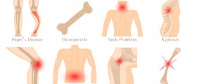 How to manage Fibromyalgia?