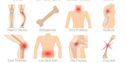 How to manage Fibromyalgia?