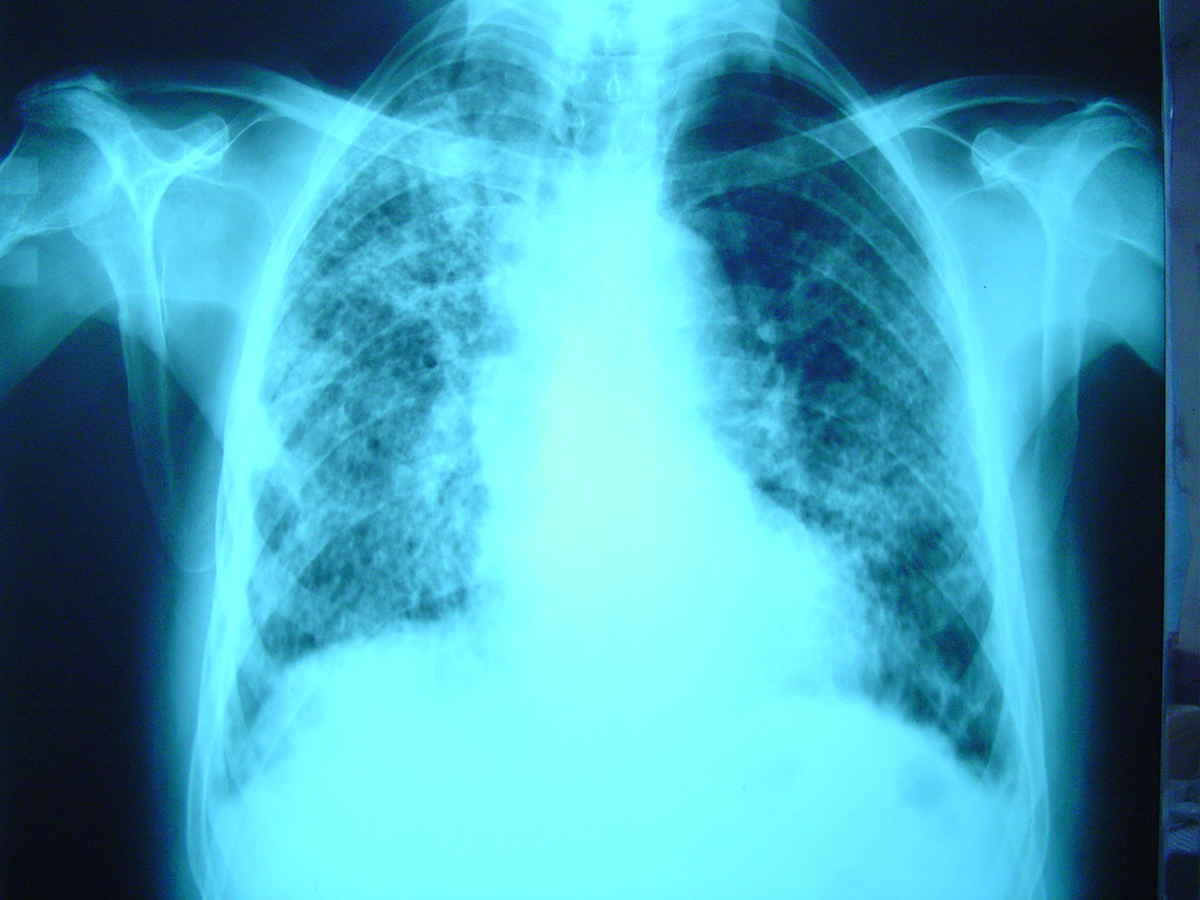 cystic-fibrosis-causes-risk-factors-respiratory-tract-disorders