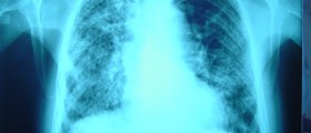 Cystic Fibrosis: Causes & Risk factors