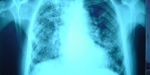 Cystic Fibrosis: Causes & Risk factors