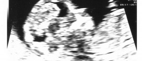 Vaginal Bleeding During The First Trimester Of Pregnancy: Not Always A Sign Of Miscarriage