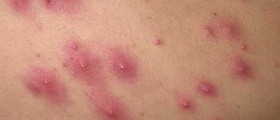 Folliculitis