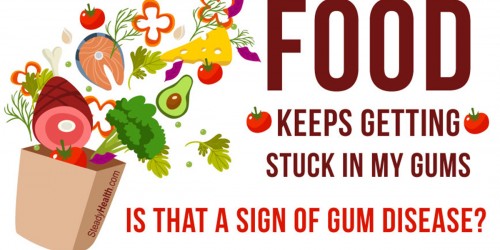 Food Keeps Getting Stuck In My Gums: Is That A Sign Of Gum Disease?