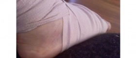Lisfranc Fracture – Commonly Missed Diagnosis