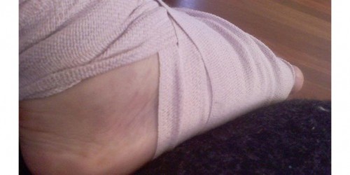 Lisfranc Fracture – Commonly Missed Diagnosis