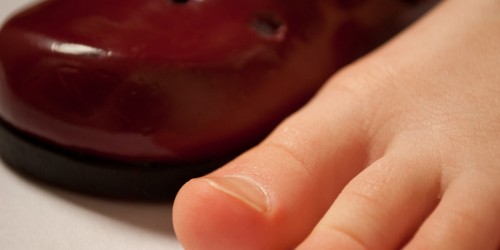 Mortons Neuroma: Symptoms and Treatment of Plantar Neuroma