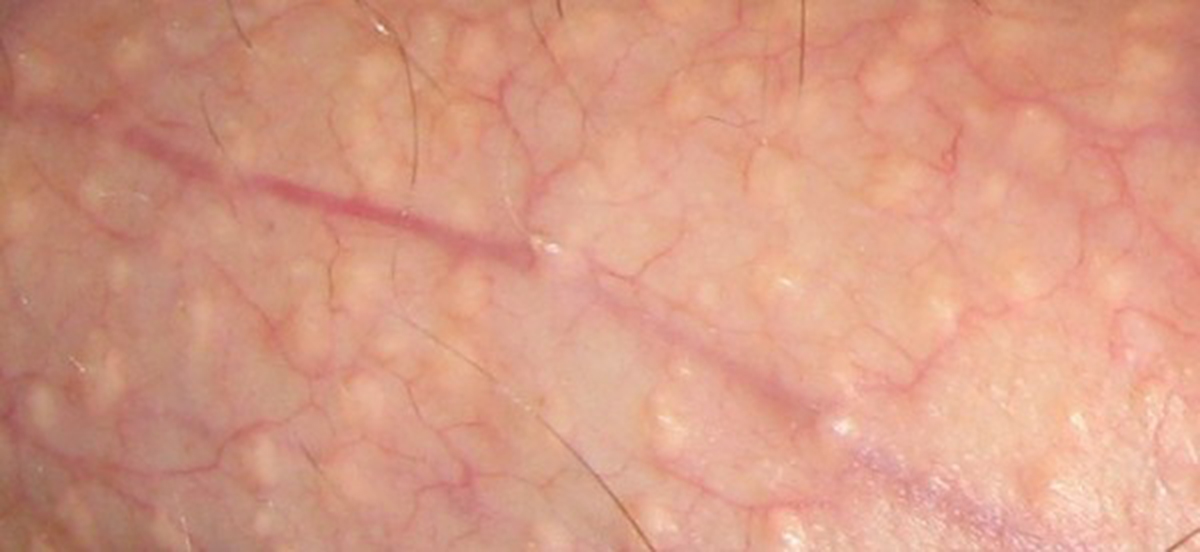 Papules tiny penile