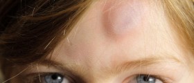 Bone Bruises: More Then Meet the Eye