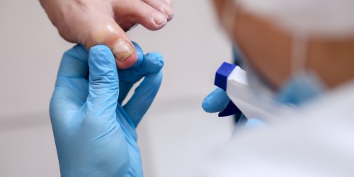 Could You Have A Fungal Nail Infection? What Are The Symptoms, And How Do You Treat Nail Fungus?