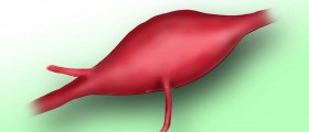Cerebrovascular disorders: Cerebral Brain Aneurysm