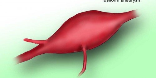 Cerebrovascular disorders: Cerebral Brain Aneurysm