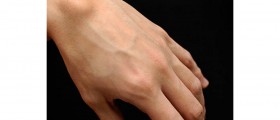Causes and Treatment of Ganglion Cysts