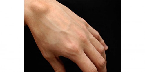 Causes and Treatment of Ganglion Cysts
