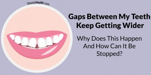 Gaps Between My Teeth Keep Getting Wider: Why Does This Happen And How Can It Be Stopped?