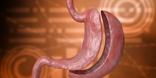 Gastric Bypass Surgery: The Best Slimming method