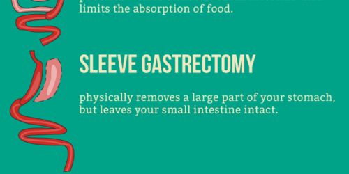 Who Should Consider Bariatric Surgery To Lose Weight?