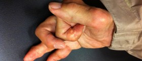 Gout: Could You Recognize This Complex Form Of Arthritis?