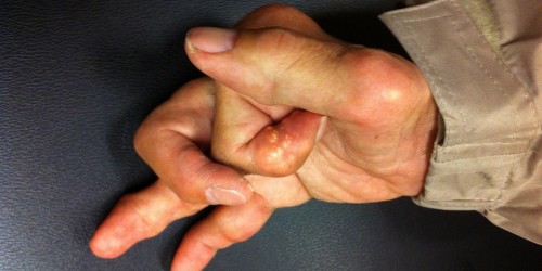 Gout: Could You Recognize This Complex Form Of Arthritis?