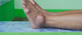 Reduce Gout Risk Naturally