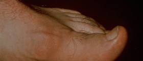 Gout and Pseudogout: Diagnosis & Treatment