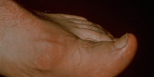 Gout and Pseudogout: Diagnosis & Treatment