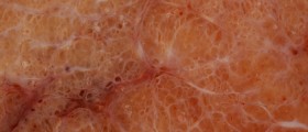 Graves' Disease: Symptoms, Treatment And Complications